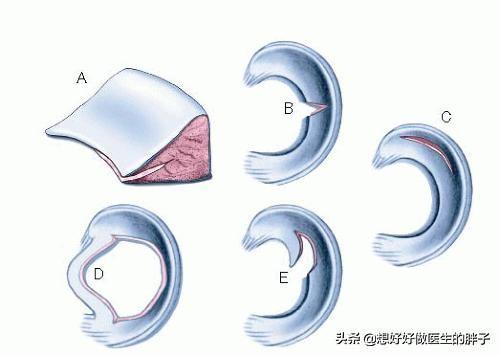 半月板三度撕裂该如何保守治疗,半月板三度撕裂还可以保守治疗吗
