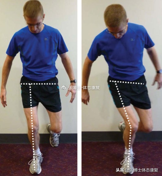 膝内扣和膝外翻是一回事吗,下蹲如何避免膝盖内扣