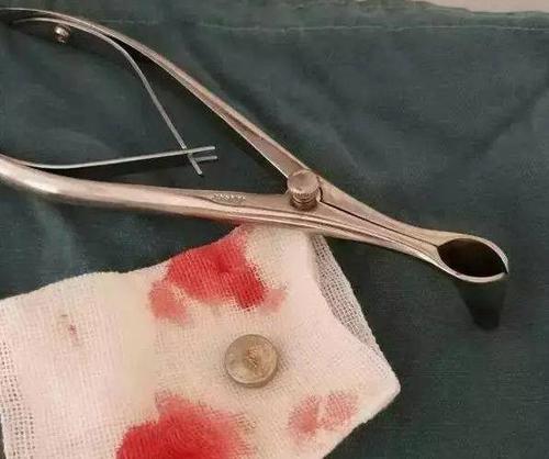 小孩吞了纽扣电池进入小肚子,宝宝误吞纽扣电池能拉出来吗