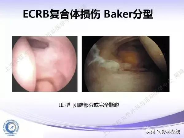 肘关节镜手术后引流,肘关节镜微创手术