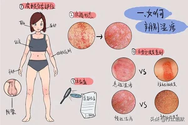 湿疹按啥穴,儿童手部湿疹艾灸取穴