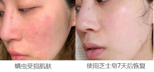 别再乱用清洁面膜了,如何正确洗脸既能白还能长痘