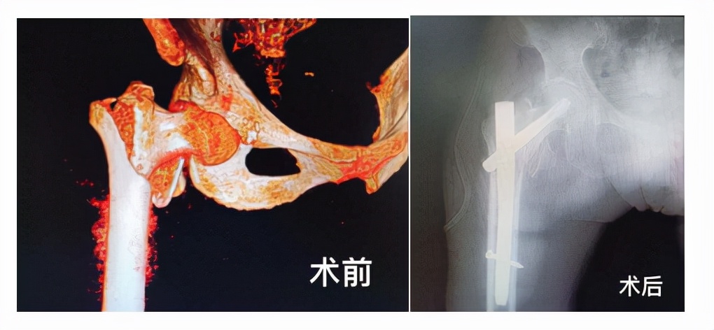 八旬老人意外骨折后续,102岁老太太骨折