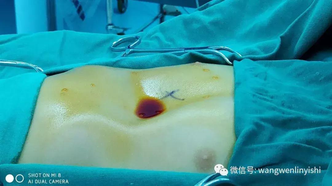 肋弓凹陷手术后需要取东西么,肋弓隆起手术