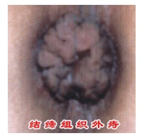 脱了裤子,我的痔疮被男朋友发现了,他被吓到了应该怎么办