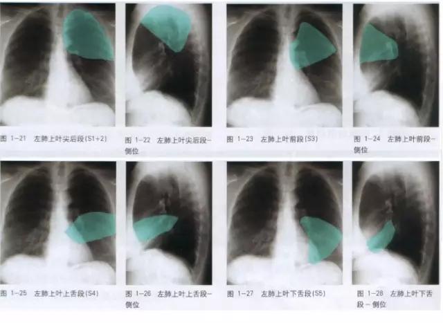 x线影像解剖大全,胸部x线怎么看懂图解