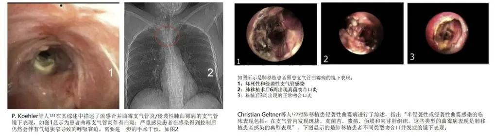 真菌培养及鉴定是阳性严重吗,怎么鉴别肺部真菌感染