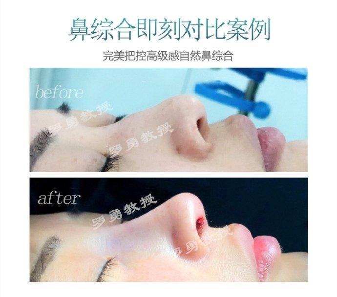 那些隆胸成功的人,那些隆鼻过的女人现在都怎么样了