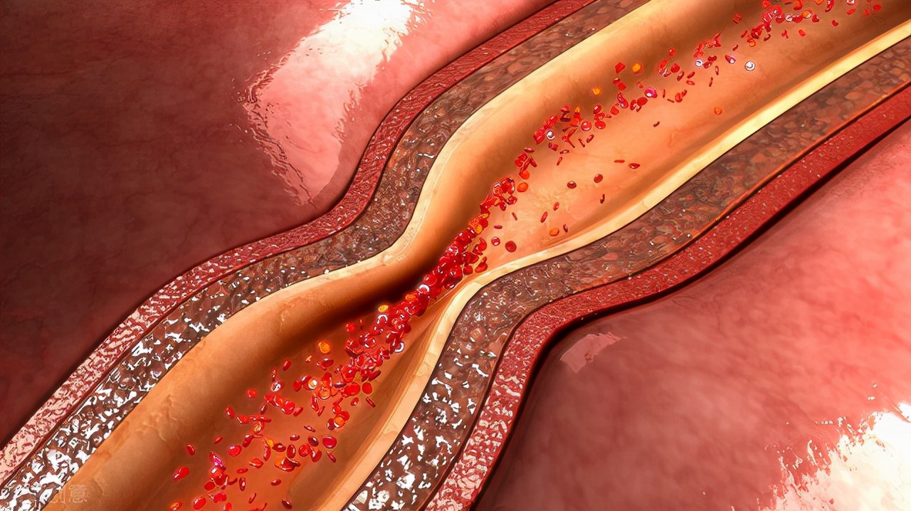 怎样预防心脏病最好方法,如何预防心脏病的方法