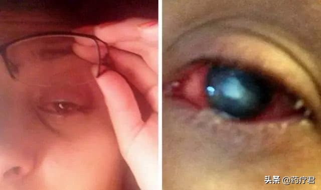 15岁女孩眼睛里长虫子,成年人眼睛长了虫子