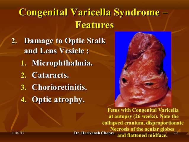水痘的讲解,关于水痘科普小知识视频