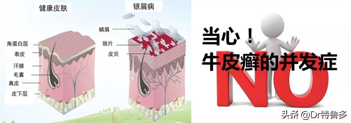 牛皮癣导致关节肿痛如何止痛,得了牛皮癣能治愈吗