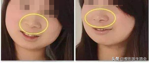鼻翼缩小会有什么影响,鼻翼缩小会不会影响鼻子呼吸