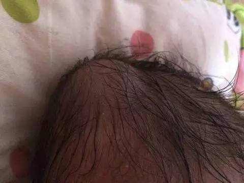 产瘤和血肿的区别ppt,婴儿头皮血肿影像