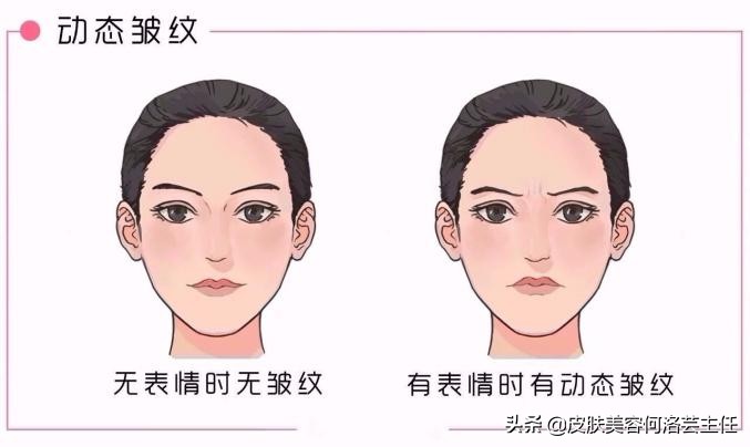 脸上有皱纹的朋友教你一个小诀窍,脸上有皱纹的原因和治疗方法