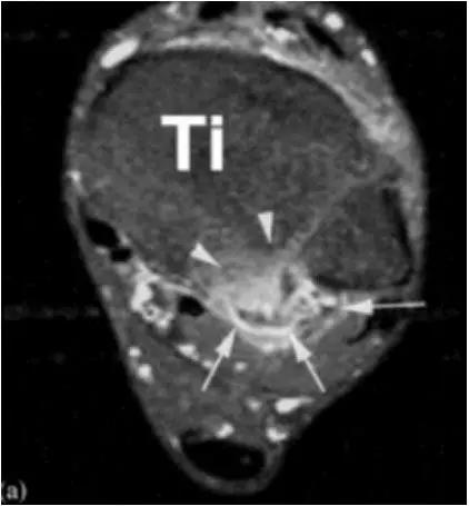 踝关节撞击症问诊,踝关节撞击综合征的x线表现