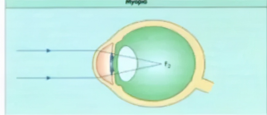 少年屈光不正怎么配镜,屈光参差的配镜原则讲解视频