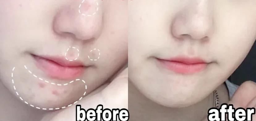 片仔癀淡化痘印凝胶,片仔癀祛痘痘贴有用吗