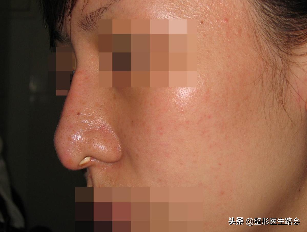 硅胶隆鼻会破坏原来的鼻子吗,隆鼻硅胶可以永久不取吗