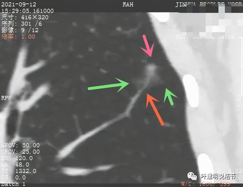 从活检怎么看是非小细胞癌,从病例谈辨证论治