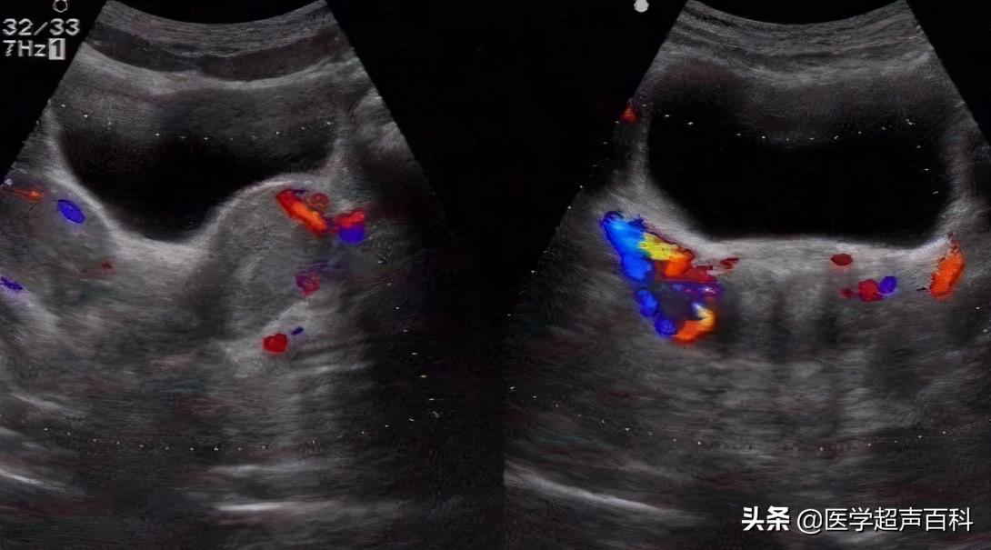 子宫发育异常能怀孕吗,幼稚子宫和子宫发育不良的区别