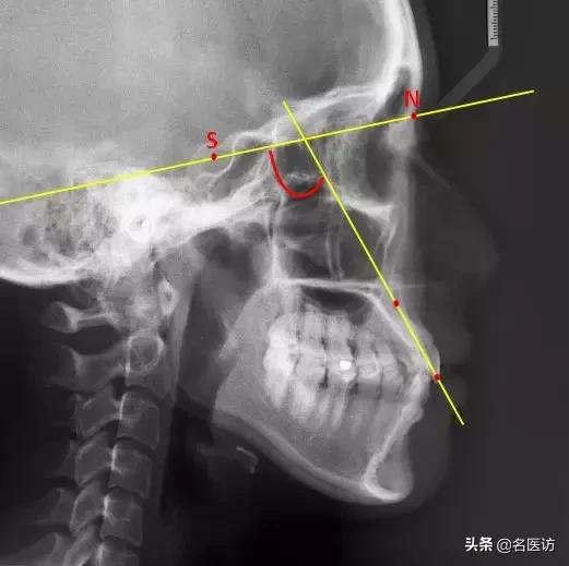 矫正科普|美人在骨不在皮，从神秘的牙片看牙齿和侧貌颜值