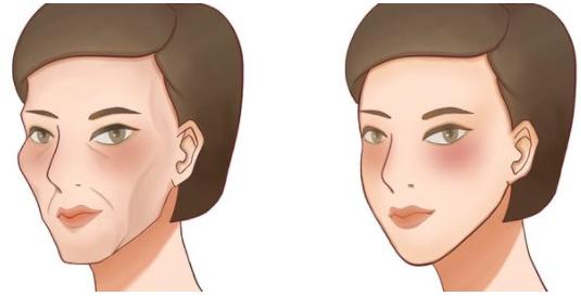 面部凹陷最好的解决办法,中面部凹陷怎么自己改善