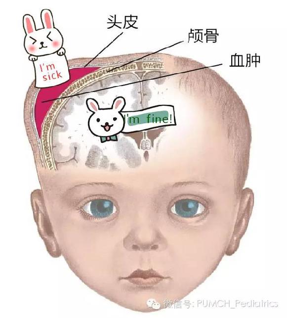 头皮血肿半年会变成瘤吗,产瘤和血肿的区别ppt