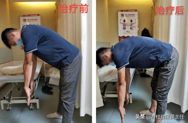 年纪大腰椎间盘突出治疗最好方法,年纪轻轻腰椎间盘突出怎么恢复