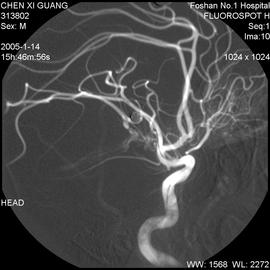 造影剂引起腹痛怎么办,造影剂会引起头疼