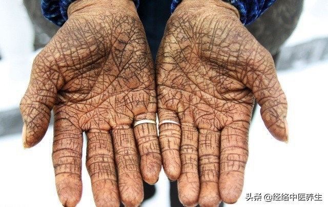 手部干裂出血，该如何安全快速治愈？