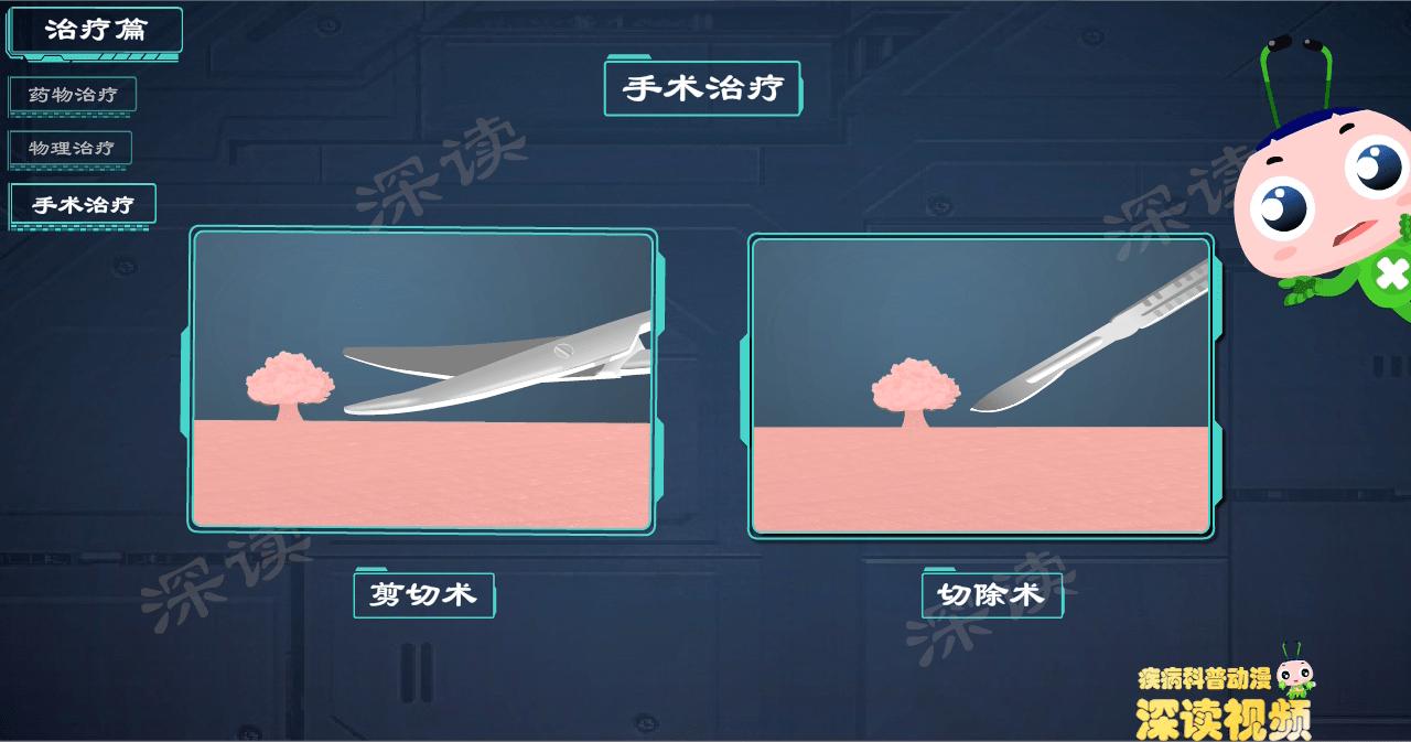 液氮冷冻治疗尖锐湿疣没感觉,液氮冷冻治疗尖锐湿疣注意事项