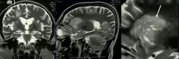 脱髓鞘病变是什么病怎么读,脱髓鞘病变的特征