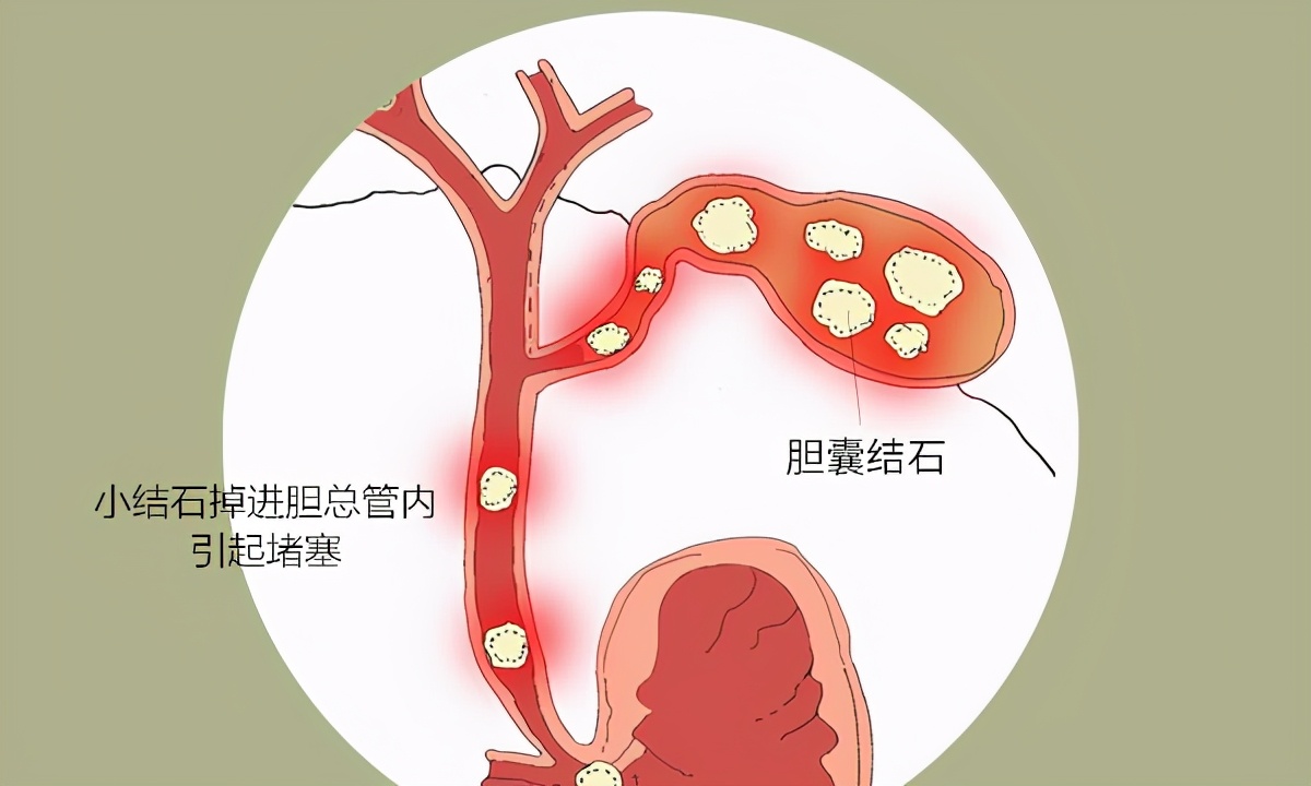 山东齐鲁医院胆囊结石保胆取石,多大的结石可以保胆取石