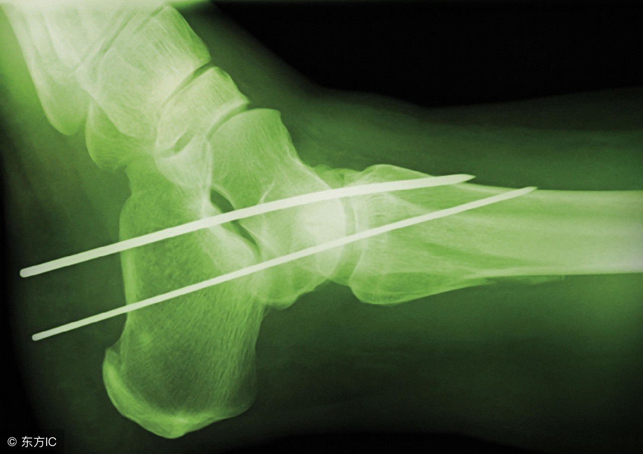 贾宗洋北京冬奥会结果,贾宗洋腿部钢钉