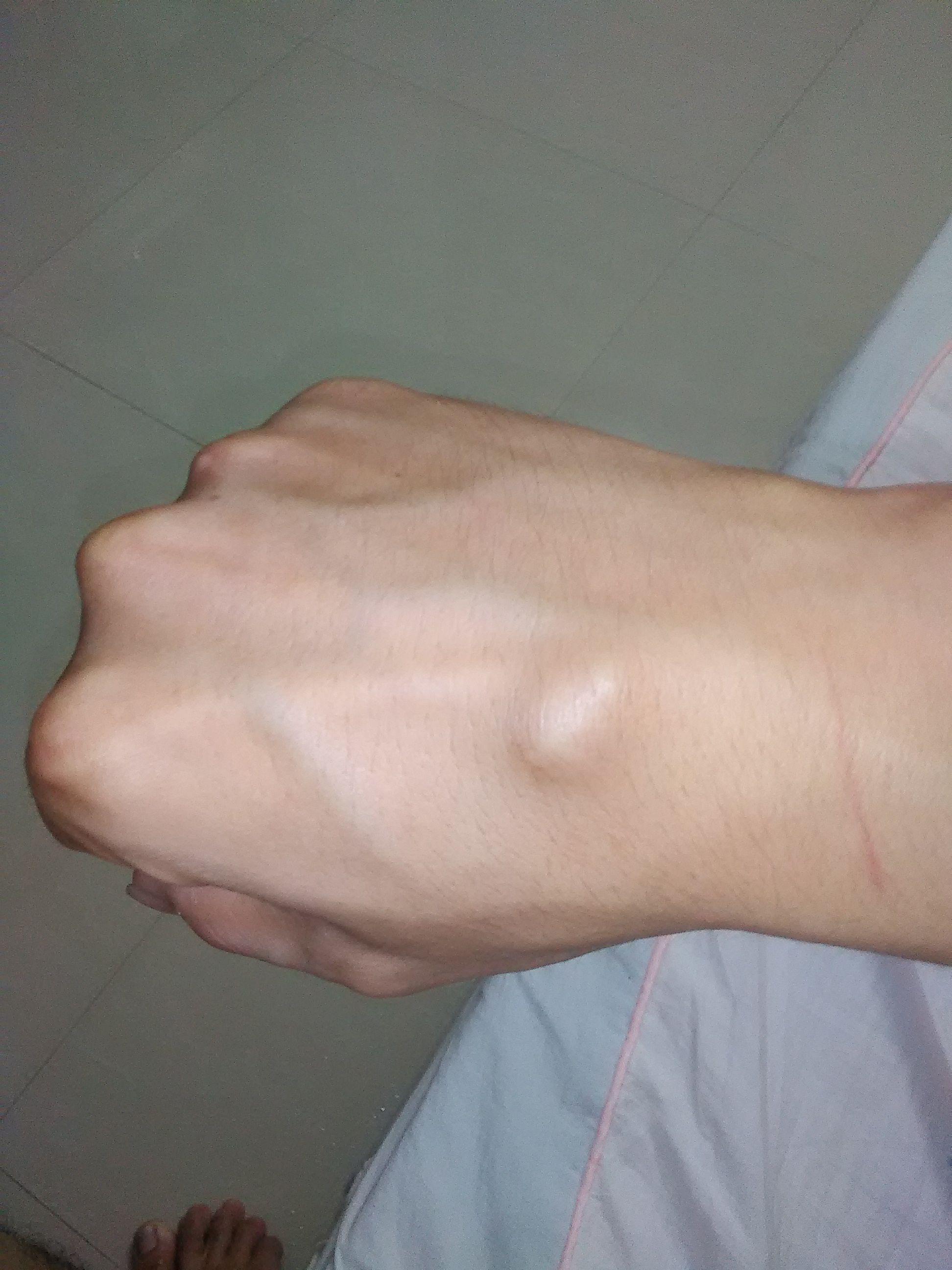 腕部腱鞘囊肿怎么治疗,奶奶抱孩子累得腱鞘炎怎么办