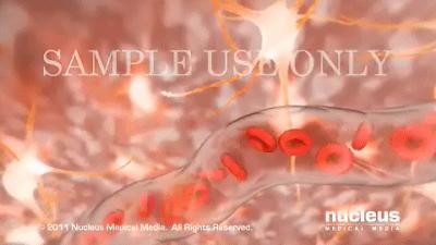 脑出血李医生,脑出血病例分析及答案