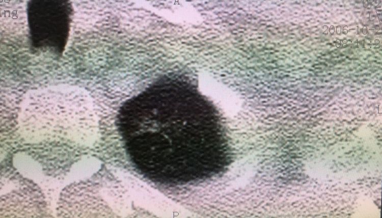 肺癌长期生存或治愈有不同吗,肺癌未治疗活了11年怎么解释