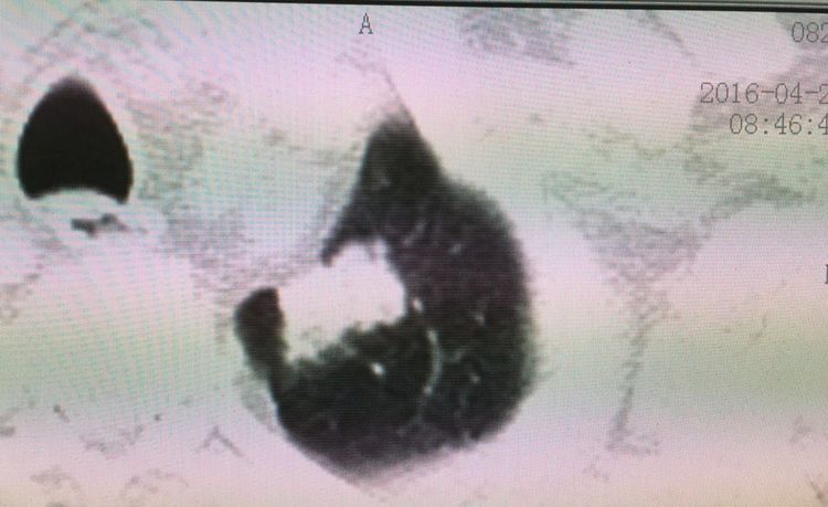 肺癌长期生存或治愈有不同吗,肺癌未治疗活了11年怎么解释