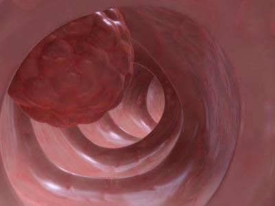 大便粘马桶什么原因怎样解决,大便粘马桶是什么原因怎么解决