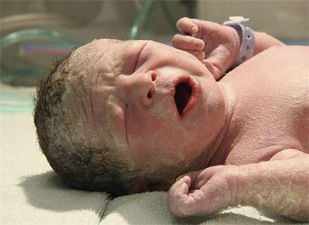 新生儿特殊生理现象照片,新生儿的正常生理现象