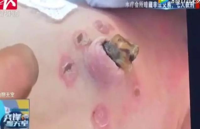 家长土方治黄疸，宝宝全身烫伤悔不当初！2种黄疸类型要分清楚！