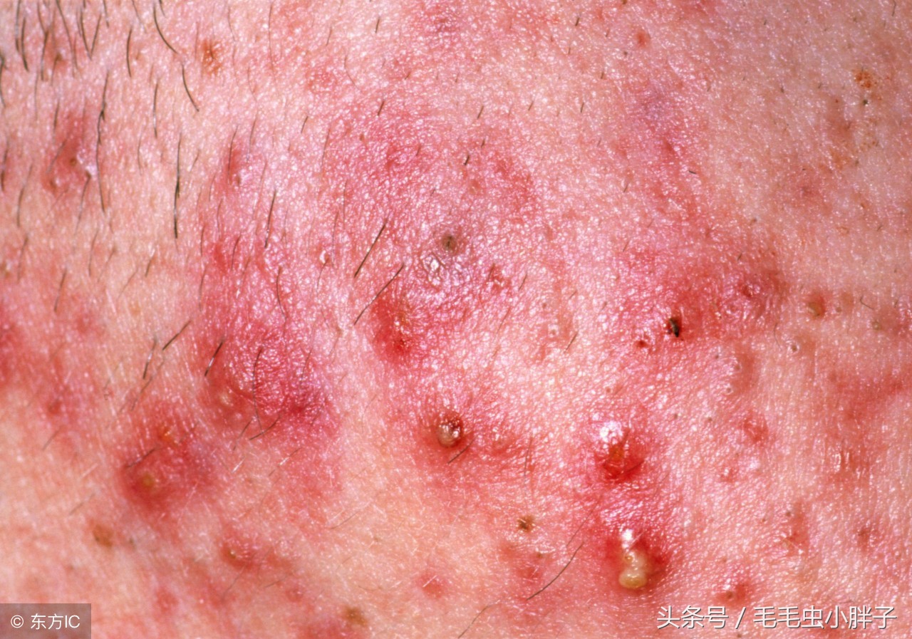 痘痘肌的处理及应对方法,痘痘大作战有没有秘籍