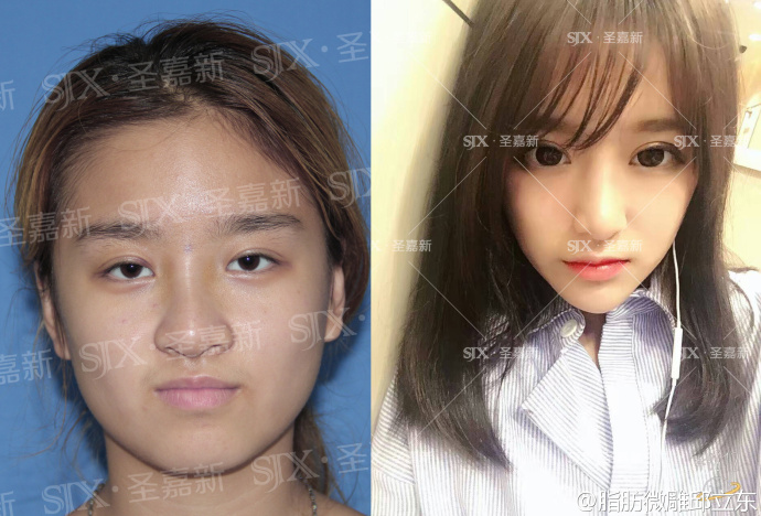 自体脂肪脸部填充能有提升效果吗,自体脂肪填充脸注意事项