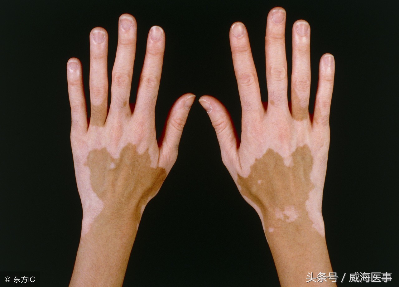 白癜风治疗新技术,白癜风激光疗法