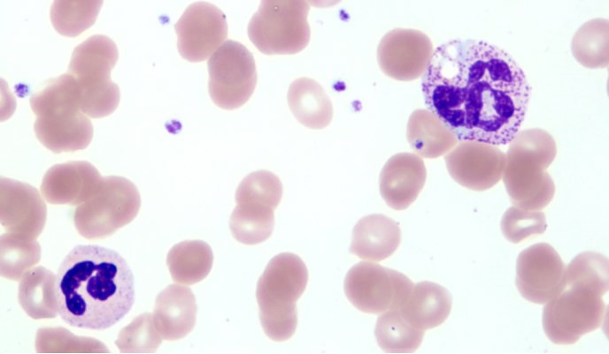 儿童血常规化验单怎么看白细胞,血常规化验单白细胞和超敏关系