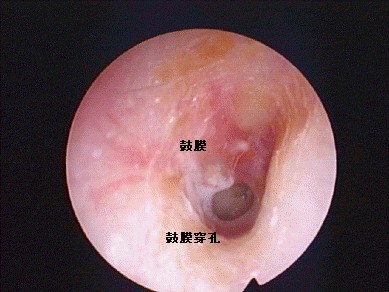 耳朵流水就是流脓,耳朵里流脓血水怎么办