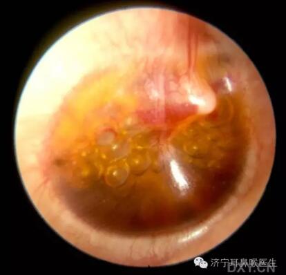 耳朵流水就是流脓,耳朵里流脓血水怎么办