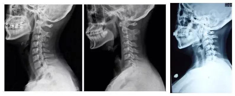 矿泉水瓶做枕头治颈椎病,用矿泉水瓶和毛巾治疗颈椎病