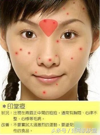 痘痘不同位置的原因及解决方法,不同阶段痘痘怎么解决